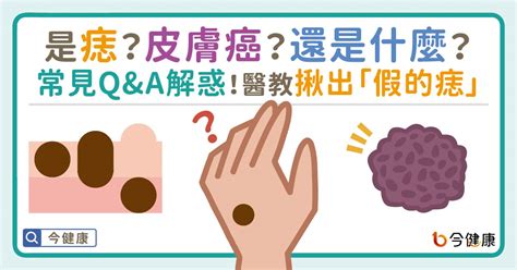 痣 顏色|是痣？皮膚癌？還是什麼？常見Q&A解惑！醫教揪出「。